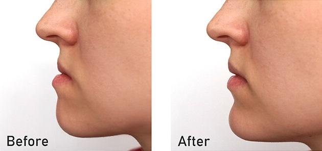 Corrective Jaw Surgery in Bangalore