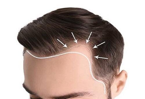 Hair Transplantation in Indranagar