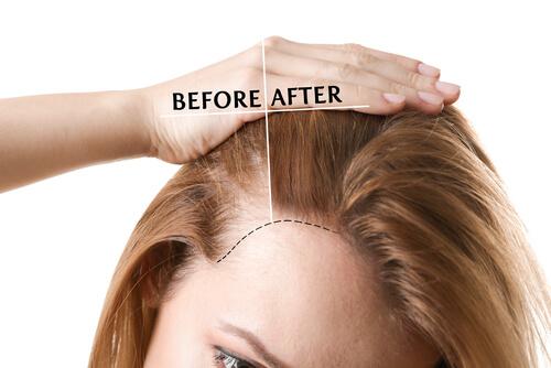 Hair Transplantation in Indiranagar