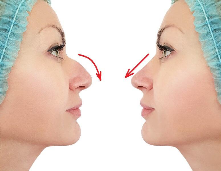 rhinoplasty