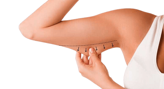 Brachioplasty Arm Lift Surgery In Bangalore