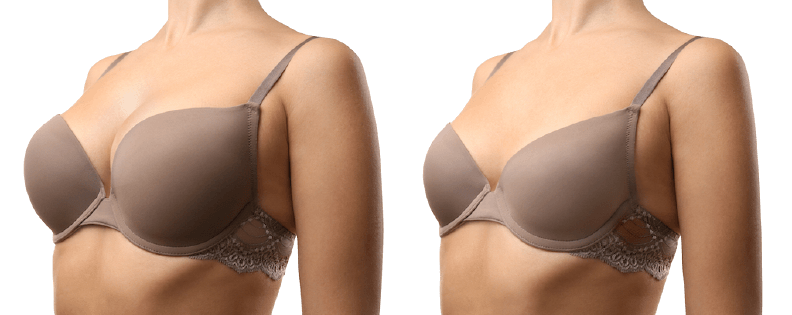 Breast Reduction Surgery Bangalore