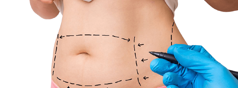 best liposuction surgeon in bangalore