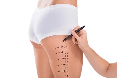 Thigh Lift Surgery in Bangalore