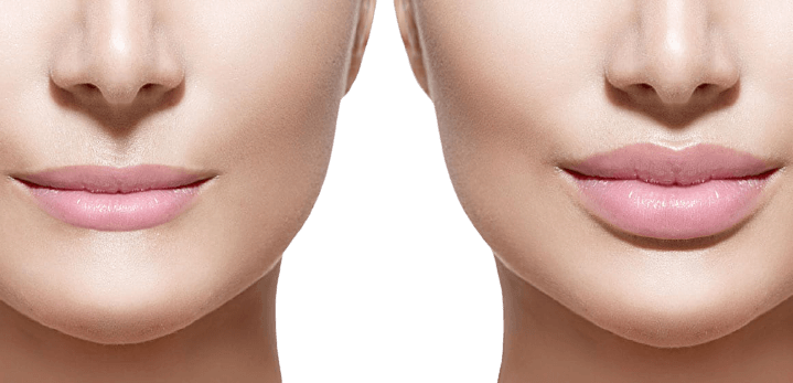 Lip Lift Surgery in Bangalore