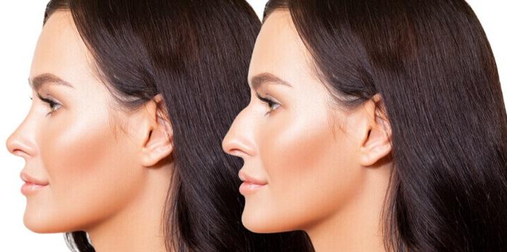 Best rhinoplasty surgeon in Bangalore